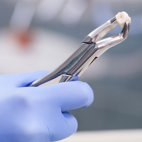 Intentional Replantation Advanced Endodontics